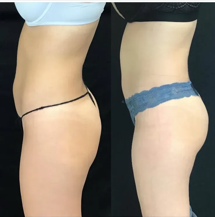 Before and after: liposuction and Renuvion of the abdomen