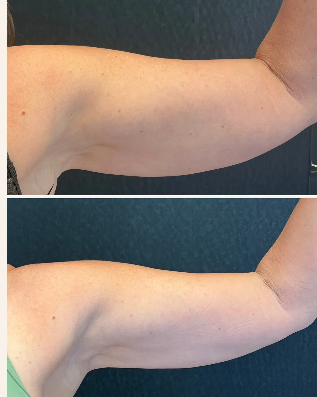 Before and after: liposuction and Renuvion of the arms