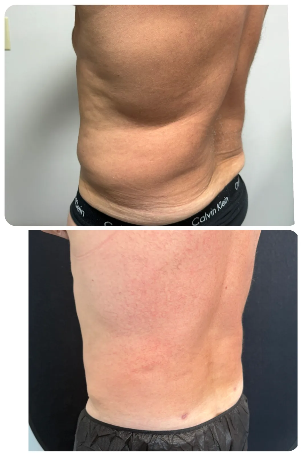 Before and after: liposuction of the flanks