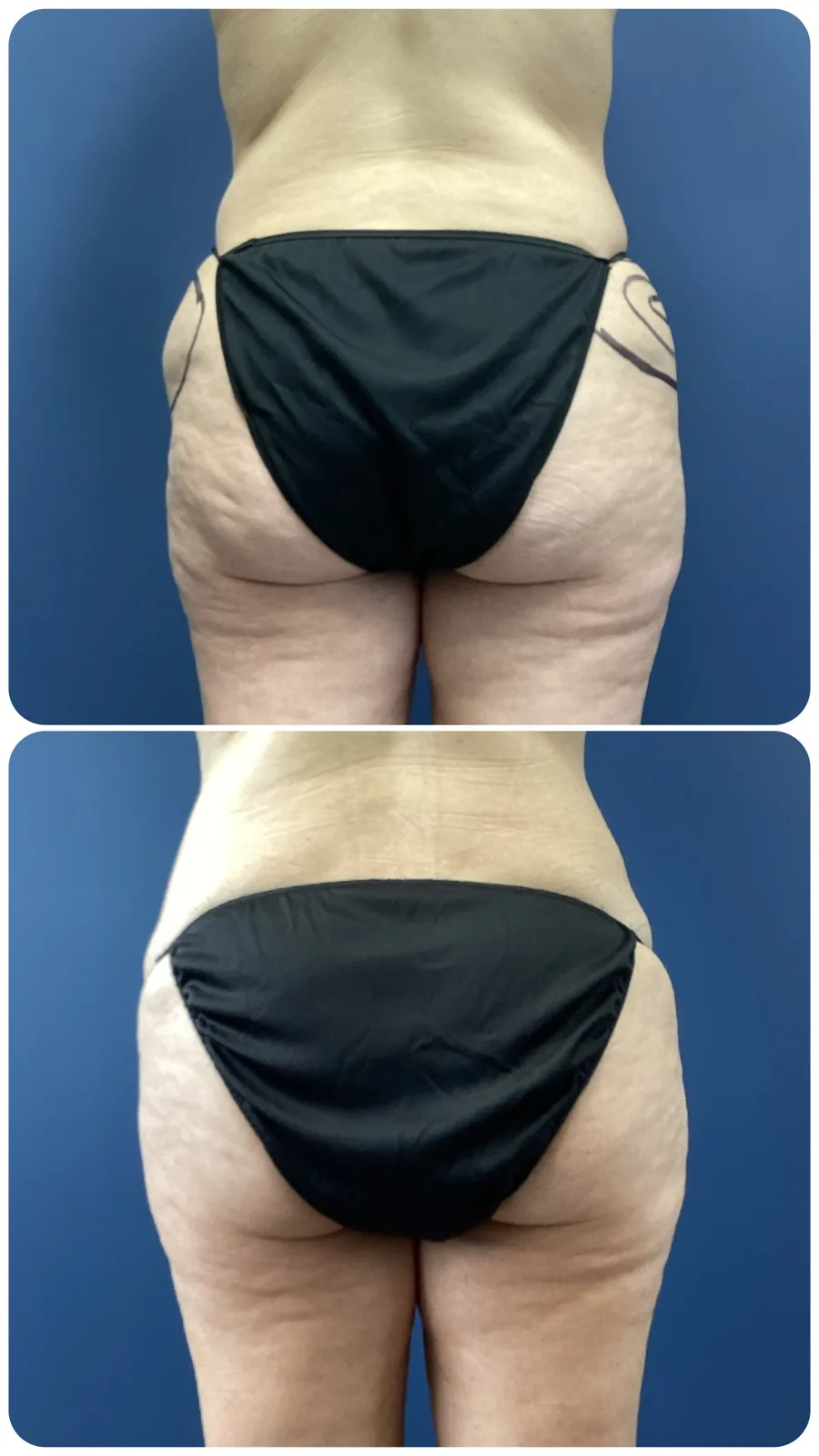 Before and after: liposuction of the outer thighs