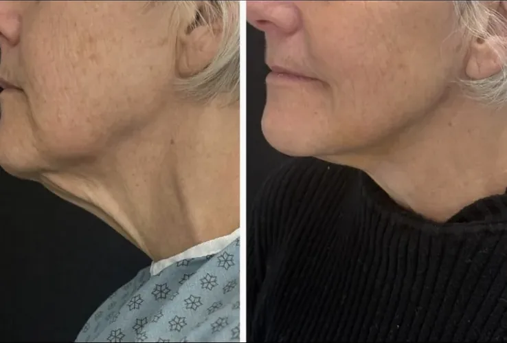 Before and after: submental (under-chin) liposuction and Renuvion